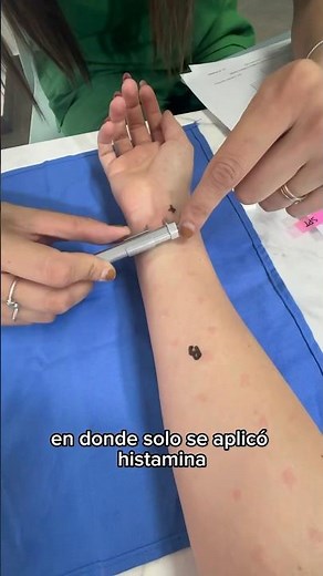 How allergy tests work