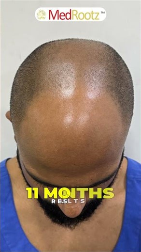5583 Grafts, Full Coverage Transformation | MedMagic at MedRootz