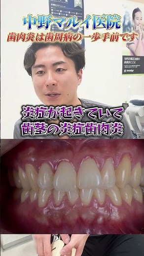 歯肉炎は歯周病の一歩手前です