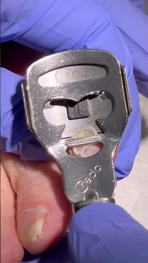 Treating corns and thickened nails on the little toe with a corn cutter