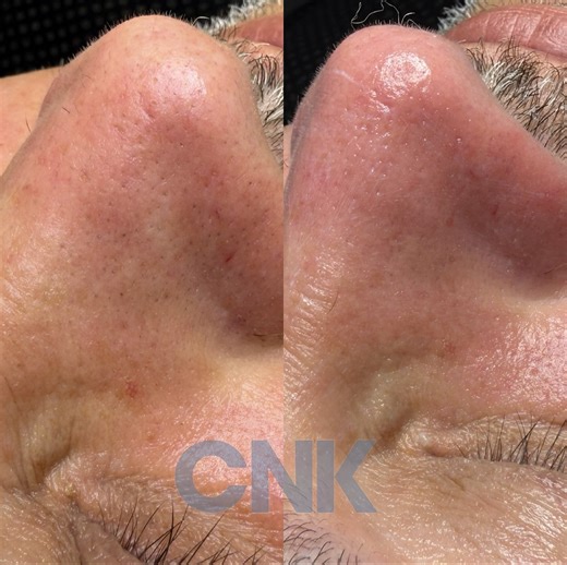 CNK Health Group | ✨ BEFORE & AFTER ✨ Client Note: Our client had a significant blackhead problem on the forehead and nose area. The pores were congested,... | Instagram