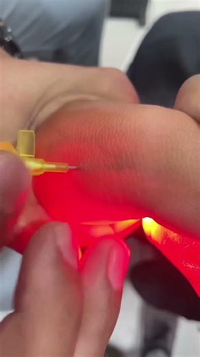 Newborn Cannulization (IV Cannula) Step by Step | Neonatal IV Insertion Guide for Nurses. #cannula