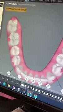 Fixing Edge-to-Edge Bite After Braces | Invisalign Case Study
