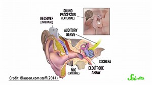 What Does A Cochlear Implant Sound Like