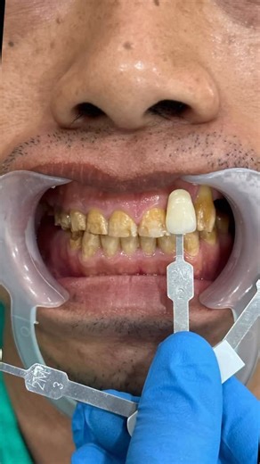 drg. Samantha Utomo, Sert. KGI on Instagram: "the biggest case of the month! Gingivectomy + My work on indirect porcelain veneers—each piece crafted to restore confidence, one natural-looking smile at a time. #Indirectveener #SmileTransformation #DentalCraft #doktergigilombok #doktergigimataram #drglombok #drgcakra #klinikgigilombok #doktergigilomboktengah #doktergigilomboktimur #tambalgigilombok #tambalgigimataram #drgmataram"