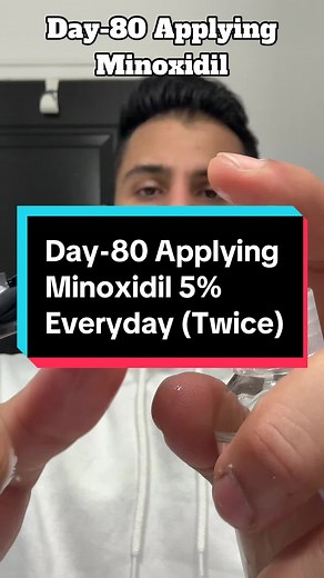Achieving Hair Growth: Minoxidil & Finasteride Routine