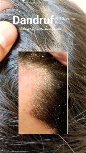 Stop Dandruff Naturally! 🌿