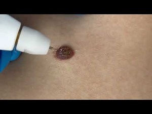 Removing Moles with Plaxel Plasma Pen Amazing Results!