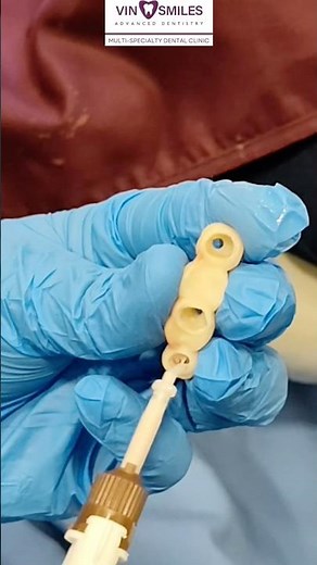 Missing Multiple Teeth? Try Implant Supported Bridge!