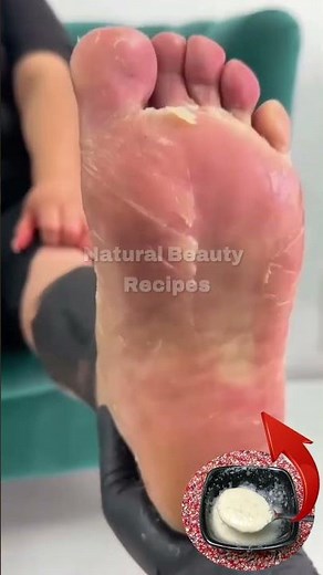 The strongest homemade recipe to deeply moisturize dry feet and heal cracked heels fast! 🦶✨