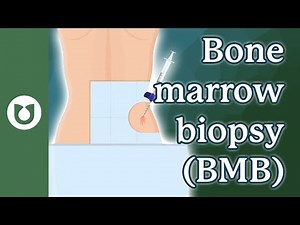 Reason of Bone Marrow Biopsies Are Essential in Myeloma: Tests and Insights #myeloma