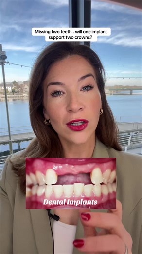 Dental Implants for Missing Teeth in Ireland