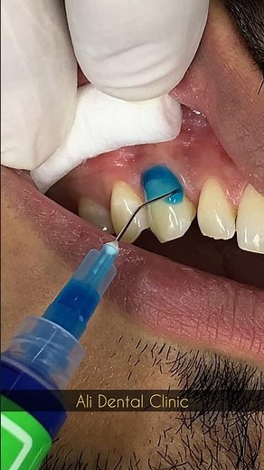 Cervical Abrasion Restoration with Composite #dental #dentist #dentalrestoration