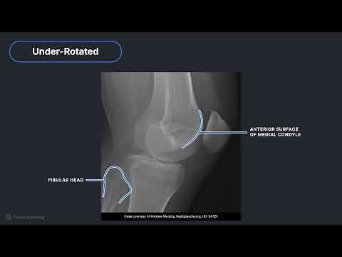 How to Recognize Key Anatomy on Radiographs of the Knee and Patella