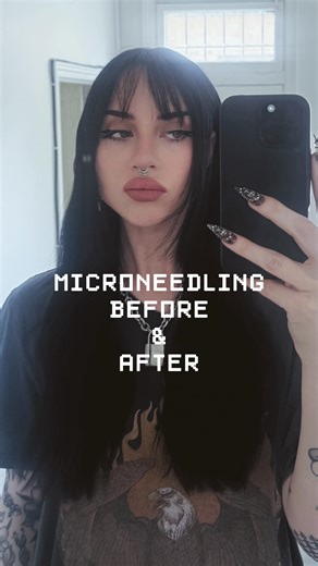 Lily on Instagram: "A bit up close and personal with this one but omg I’m hooked. I have another appointment in a few weeks! I wouldn’t recommend doing it during a heat wave like I did though 🫠 - - - #microneedling #altstyle #microneedlingbeforeandafter"