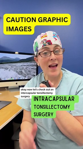Watch a real intracapsular tonsillectomy surgery in action and learn all about this technique! Intracapsular tonsillectomy can reportedly reduce pain, bleeding, and recovery time compared to traditional tonsillectomy methods. BUT it also does leave the door open for the tonsils to grow back (1-3%). This video will show you the process of this technique and how it differs from a complete tonsillectomy. #intracapsular #tonsillectomy #surgery #minimallyinvasive #medicalvideo #ENT #healtheducation #