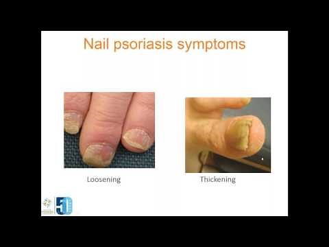 Nail Psoriasis Patient - Educational Webinar