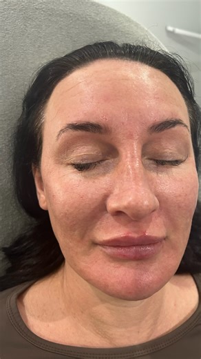 Aesthetics by Beauty Essentials on Instagram: "Freestyle dermal filler 💉✨ A personalised approach to facial enhancement — no “one-size-fits-all” mapping. Freestyle filler focuses on your unique anatomy, movement, and aesthetic goals to restore balance, volume, and definition exactly where it’s needed. What it can help with: • Softening lines & folds • Enhancing lips, cheeks, jawline & chin • Restoring lost volume • Creating natural, balanced results Why choose freestyle? Every face is different