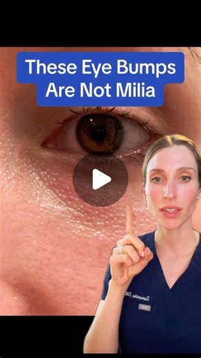Sam Ellis, MD, FAAD | Dermatologist on Instagram: "Do you have these? #oilglands #milia #dermatology #dermatologist"