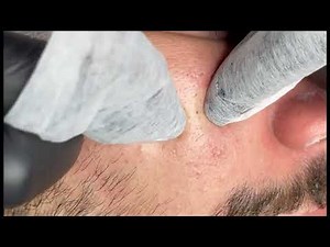 Remove Nose Blackheads at Home ‪@removeblackhead‬