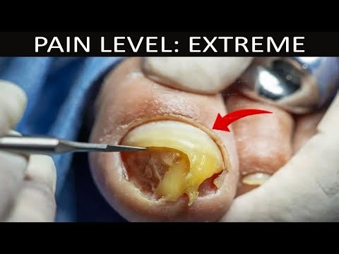 How to Treat Ingrown Toenails at Home Safely (No Pain Tricks)