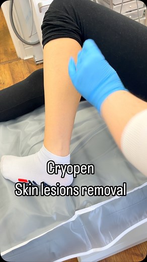 Cryotherapy (also known as Cryosurgery) is a safe and highly effective method of freezing and removing benign skin lesions such as skin tags, pigmentation, solar lentigines (sunspots, liver spots etc.), seborrheic keratosis, warts and verrucas. Book a consultation with us today. #skinlesions #cryopen #cryotherapy #skintagremoval #skinclinic #newcastleupontyne #jesmond #skin #skintags | Nova Skincare Clinic