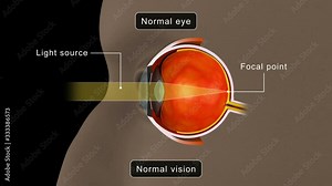 Differences between Hyperopia (farsightedness) and Myopia (nearsightedness).