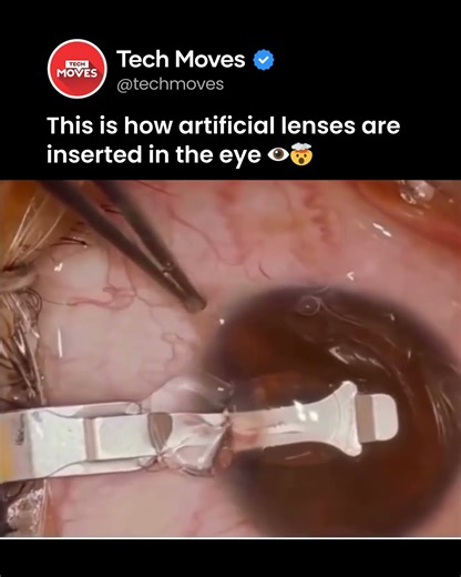 This is how artificial lenses are inserted in the eye👀