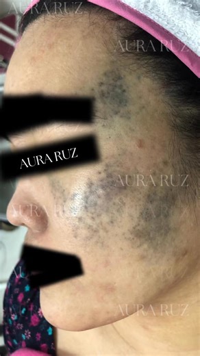 ✨ Aura Ruz Birthmark Treatment ✨ Say goodbye to stubborn birthmarks the safe and effective way! At Aura Ruz Medical Aesthetics Group, we use the PicoSure Pro — the world’s first and only 3x more powerful picosecond laser. ✔️ Targets pigment safely without harming surrounding skin ✔️ Fast & effective sessions with minimal downtime ✔️ Works for different types of birthmarks (dark, flat, or pigmented) ✔️ FDA-cleared, branded machine – no fake lasers, only the best technology Because every mark tell