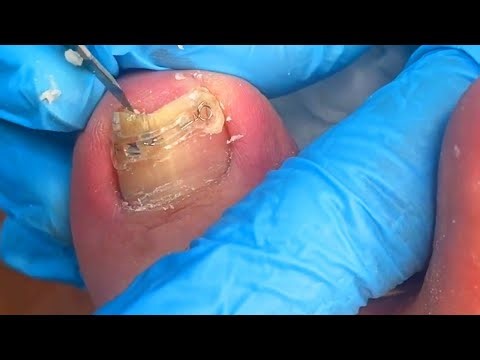 Nails full of viruses, severe onychomycosis