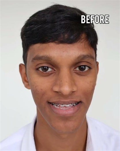 Avoid Smiling Because of Jaw Problems? Orthognathic Surgery is the Solution! Dr Mathew PC #shorts
