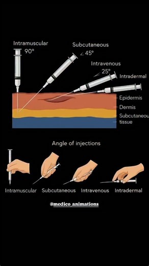 medical_animation on Instagram: "Not All Shots Are Created Equal – Your Quick Guide to Injection Types Ever wondered why some shots go in your arm muscle and others just under the skin? Here’s the breakdown: Intramuscular (IM) → Deep into the muscle (vaccines, hormones) Subcutaneous (SC) → Into the fatty layer (insulin, blood thinners) Intravenous (IV) → Straight into the vein (instant effect) Intradermal (ID) → Just under the skin surface (TB tests, allergy testing) Intraosseous (IO) → Into bon