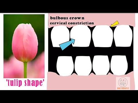 Dentinogenesis Imperfecta