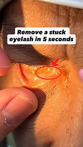 Dr. Andrew Low | Ophthalmologist | 眼科专科医生 on Instagram: "👁️ How to remove a stuck eyelash from your eye (the fast & safe way) If you’ve ever had an eyelash stuck in your eye or conjunctiva sac, here’s what NOT to do ❌ and the safest way ✅ to get it out. ⸻ ❌ Wrong ways (don’t do this): ✘ Using your nails : scratches your cornea and spreads germs. ✘ Tweezers or clippers : too sharp, too risky. ✘ Rubbing your eye : friction from the lash may hurt your cornea. ✘ Using sharp objects : too dangerous.