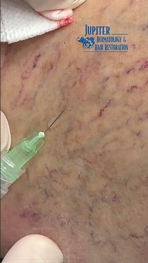Goodbye to Spider Veins! Dr. Mejia performs Sclerotherapy 💉