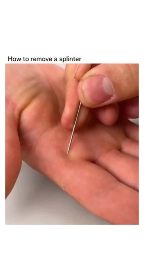 Detailed Explanation on Instagram: "If you have a syringe (the kind without a needle) or a bulb syringe, draw warm, clean water into it; warm water helps soften the skin and makes the splinter easier to move. Hold the skin taut around the splinter so it doesn’t bunch up, aim the syringe tip at the entry point from a small distance (a few millimetres), and gently flush the area with a steady stream — the force of the water can often lift or wash out shallow splinters. After flushing, if the splin