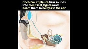 Who invented the bionic ear? - video Dailymotion