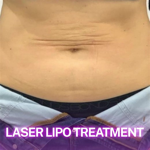 👋 San Rafael Ladies! This month, we’re celebrating the skin you’re in — and that includes your midsection. Our Lipo Laser Belly Sculpting Treatment is the non-invasive way to target stubborn fat and loose skin for a flatter, more sculpted waistline — no surgery, no downtime. For a limited time, get it for just $59 (Reg. $499) — that’s a $440 SAVINGS for the first 15 new clients! Our advanced treatment targets: 🔹 Stubborn Belly Fat 🔹 Loose Skin 🔹 Love Handles 🔹 Cellulite 🔹 Waistline Contour