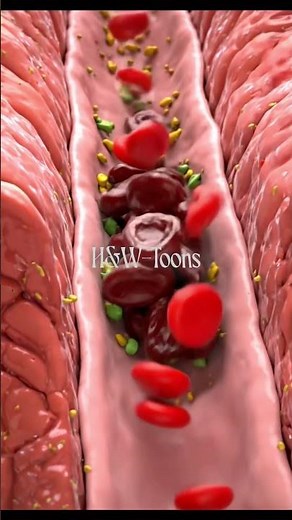 SICKLE CELL CRISIS: The Vaso-Occlusive Blockade #SickleCellCrisis #VasoOcclusiveCrisis #Hematology