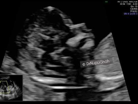 Measuring the Nuchal Translucency (NT) ‪@drnupurshah‬