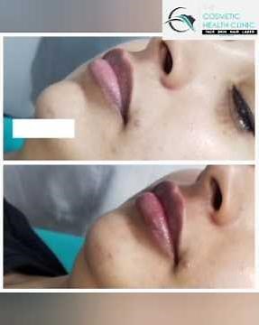 💋 How Does Lip Filler Work? 💉✨Ever wondered how lip fillers give that plump, juicy pout?
