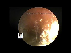 ear wax removal,cerumen and fugus cleaning.20220604