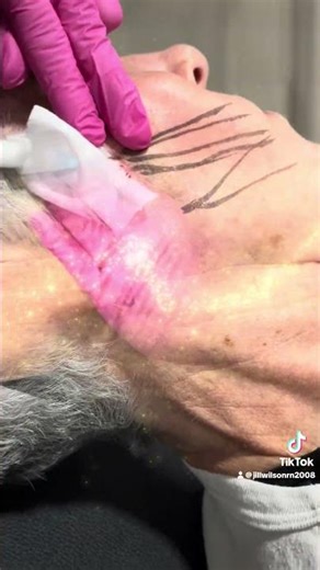 Hyperdilute Radiesse.