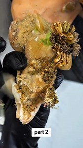 24K views · 136 reactions | ingrown toenail removal satisfying videos with swollen | CTH TV2 | Facebook