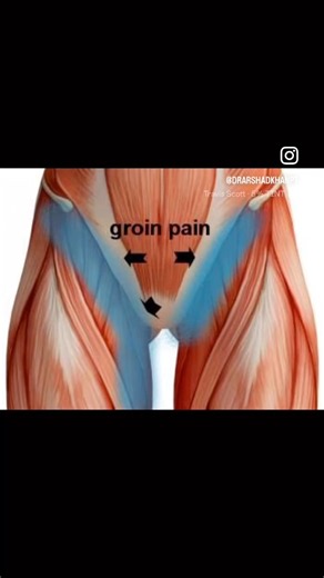 Acute groin pain treatment