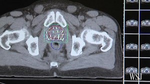 Prostate Cancer: Early Treatment Doesn't Impact Death Rate