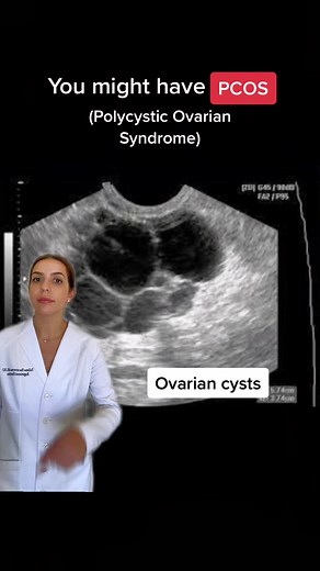 PCOS Weight Loss on TikTok