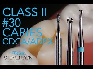 Class II Amalgam Preparation #30 MO CARIES! | Dr. Richard Stevenson