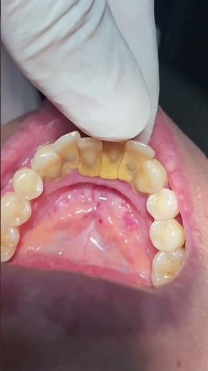 Teeth mobility #dentistteeth #dentist #dentaltreatment
