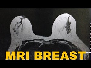 HOW TO DO MRI BREAST